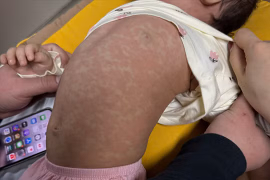 Nhiều trẻ mắc bệnh sởi những ngày đầu năm