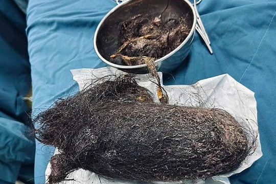 Bóc búi tóc khổng lồ nặng 900 gram được lấy từ trong dạ dày bé gái 12 tuổi ở Quảng Ngãi. Ảnh BVCC.