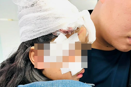 Một trường hợp bệnh nhi bị chó cắn phải nhập viện (Ảnh BVCC)