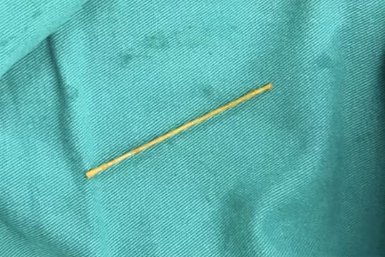 Cây tăm xỉa răng được lấy ra từ tá tràng của bệnh nhân