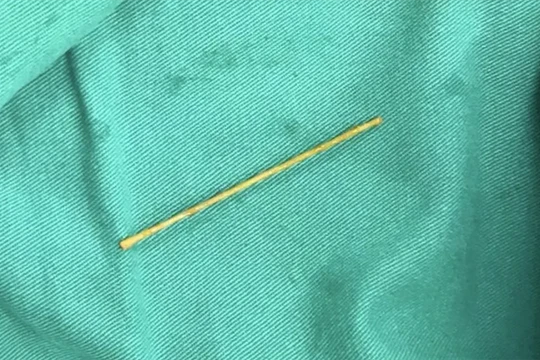 Cây tăm xỉa răng được lấy ra từ tá tràng của bệnh nhân