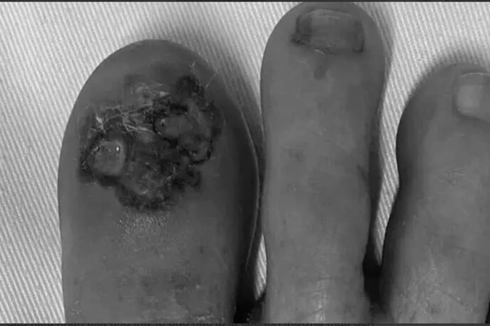 Ngón chân bệnh nhân bị có mảng màu đen, loét, rỉ dịch và chảy máu do ung thư tế bào hắc tố