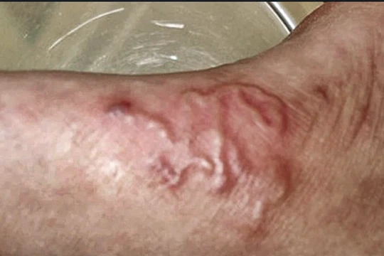 Ấu trùng sán dây chó ký sinh dưới da bệnh nhân (ảnh BVCC)