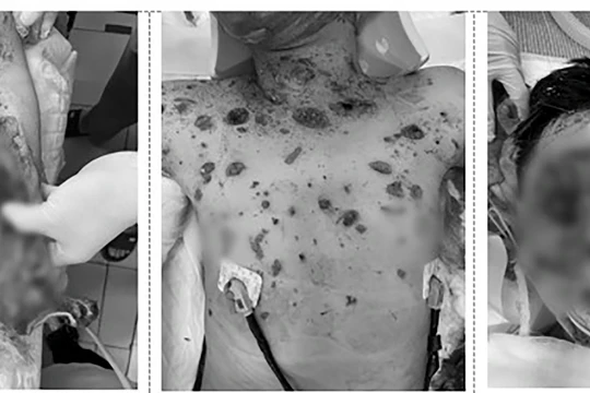 Nạn nhân bị đa chấn thương sau vụ nổ laptop (Ảnh BVCC)