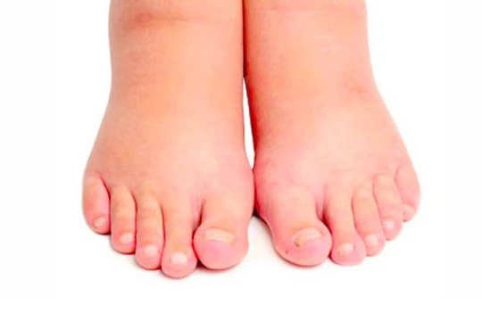 Phù, nề khiến cơ thể sưng đau khó chịu 