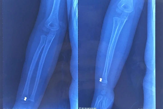 Hình ảnh đạn súng hơi găm trong tay bệnh nhi