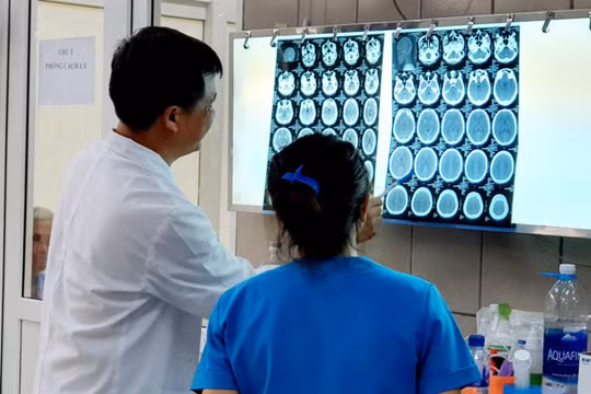 Hình ảnh phim chụp não bệnh nhân bị xuất huyết do ngộ độc ma túy đá