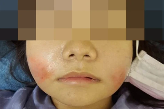 Khuôn mặt sưng tấy của người bệnh sau khi tiêm filler