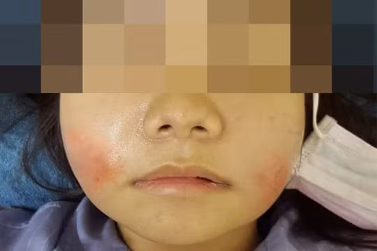 Khuôn mặt sưng tấy của người bệnh sau khi tiêm filler