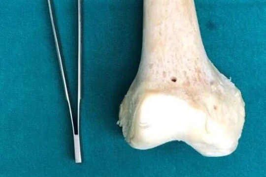 Xương được sử dụng để thay khớp gối cho bệnh nhân