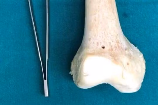 Xương được sử dụng để thay khớp gối cho bệnh nhân