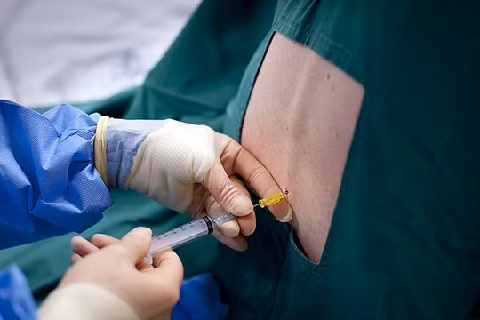 Gây tê tủy sống 