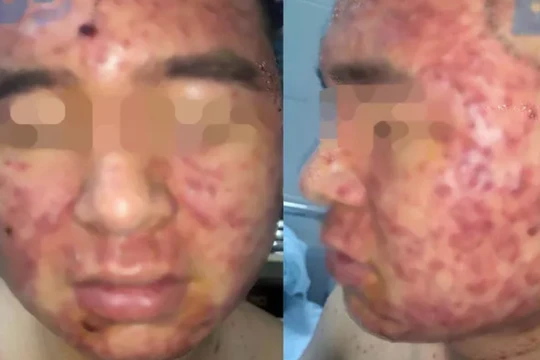 Sử dụng thuốc nam, nam thanh niên bị mụn chi chít. (Ảnh bệnh viện cung cấp) 