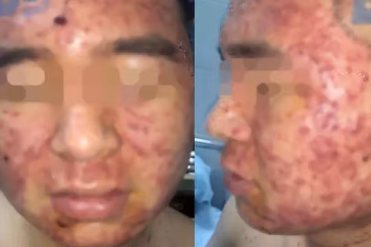 Sử dụng thuốc nam, nam thanh niên bị mụn chi chít. (Ảnh bệnh viện cung cấp) 