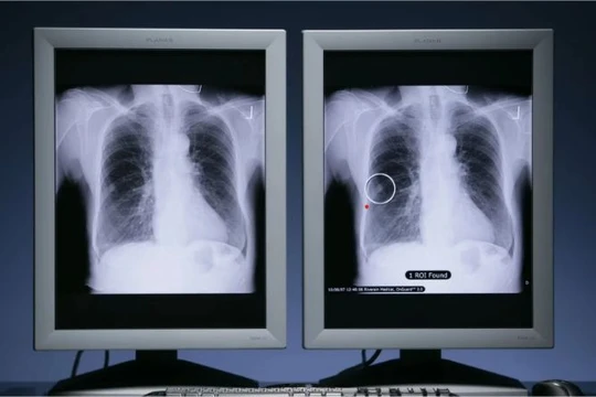 Ung thư phổi là loại bệnh phổ biến nhất trên toàn thế giới, ước tính có 2,5 triệu ca mới trên toàn cầu vào năm ngoái. Ảnh: PR NEWSWIRE.