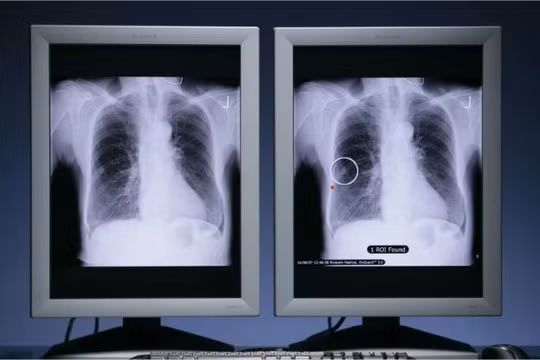 Ung thư phổi là loại bệnh phổ biến nhất trên toàn thế giới, ước tính có 2,5 triệu ca mới trên toàn cầu vào năm ngoái. Ảnh: PR NEWSWIRE.