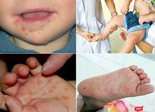 Y tế TP HCM cảnh báo nguy cơ gia tăng tử vong của bệnh tay chân miệng