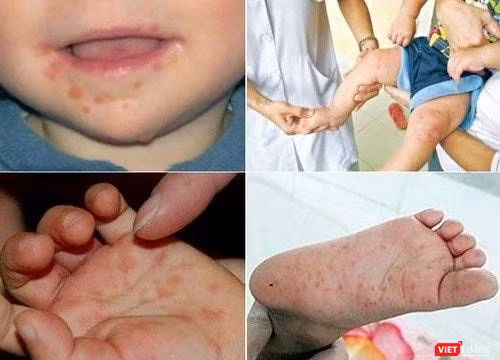 Chuyên gia y tế HCDC đưa ra hướng dẫn phòng tránh tay chân miệng cho trẻ