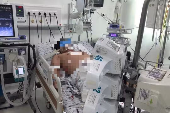 Bệnh nhân sốc sốt xuất huyết nặng điều trị tại Bệnh viện Nhi đồng Thành phố (TP HCM). Ảnh: BVCC