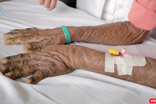 Hai tay của một nạn nhân nhiễm độc thuốc nam điều trị tại Bệnh viện Chợ Rẫy