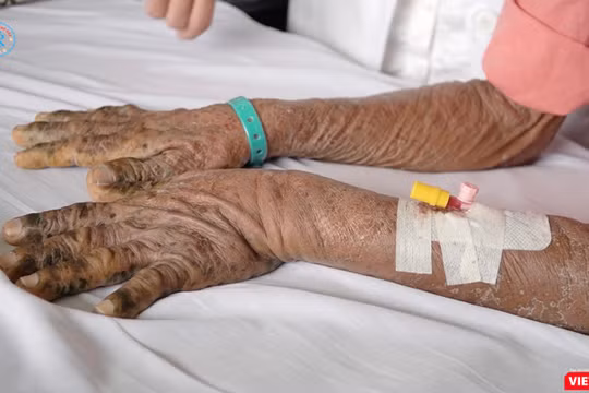 Hai tay của một nạn nhân nhiễm độc thuốc nam điều trị tại Bệnh viện Chợ Rẫy