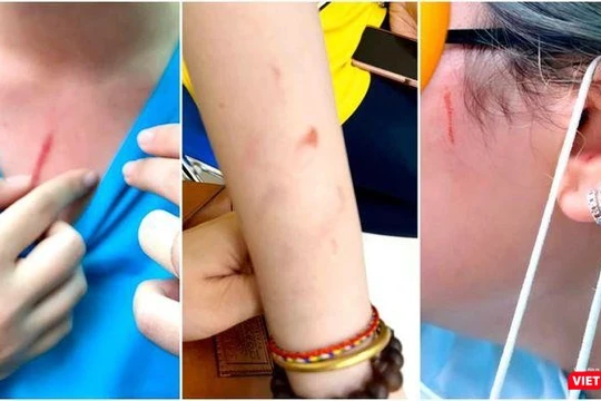 Nữ sinh bị nhiều vết thương sau vụ ẩu đả. Ảnh cắt từ clip được livestream