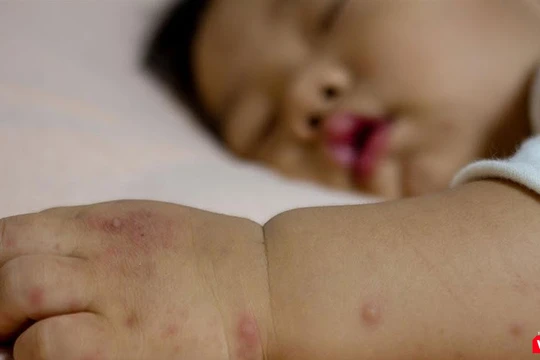 Bệnh tay chân miệng có nhiều biến chứng nguy hiểm. Ảnh: Bệnh viện Đa khoa Tâm Anh