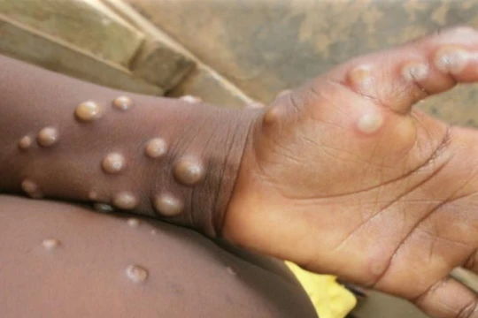 Bệnh đậu mùa khỉ đang lây lan nhanh tại nhiều quốc gia 