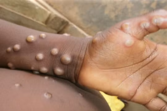 Bệnh đậu mùa khỉ đang lây lan nhanh tại nhiều quốc gia 