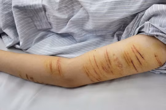 Người trẻ rủ nhau tự gây thương tích, bác sĩ chỉ ra nguyên nhân kèm lời khuyên