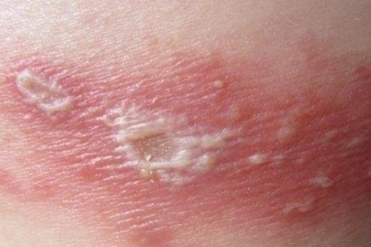  Cô đơn, căng thẳng làm tăng nguy cơ mắc zona thần kinh