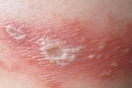  Cô đơn, căng thẳng làm tăng nguy cơ mắc zona thần kinh