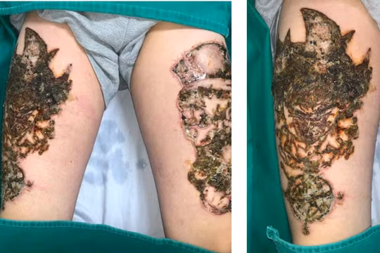 Xóa xăm ở cơ sở không an toàn dẫn đến nhiễm trùng nặng (ảnh: Lê Vinh)