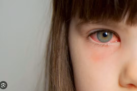 Hôm nay, Sở Y tế TP HCM công bố đã xác định được tác nhân gây bệnh đau mắt đỏ trên địa bàn