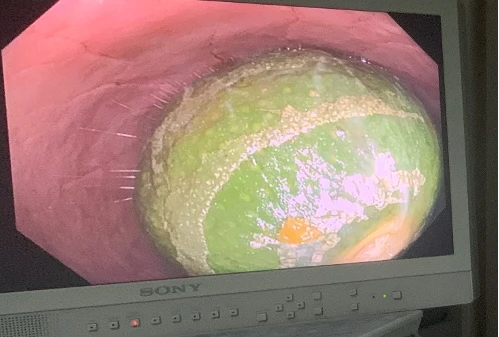 Nam thanh niên nhét con lươn dài 65cm vào hậu môn, phải mổ cấp cứu