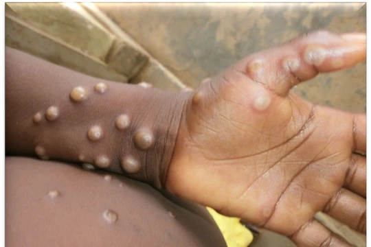 Triệu chứng biểu hiện của bệnh đầu mùa khỉ