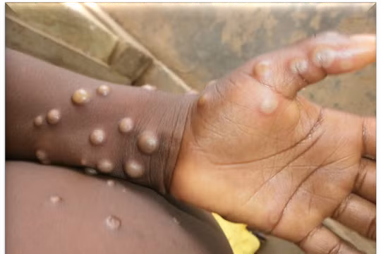 Việt Nam đang tăng cường phòng, chống bệnh đậu mùa khỉ, đặc biệt sau ca nhiễm đầu tiên được phát hiện tại TP.HCM