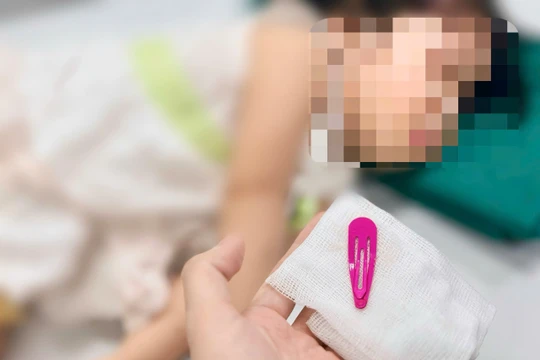 Bé gái 21 tháng tuổi nuốt kẹp tóc vào bụng - cảnh báo tai nạn ở “khối nghỉ hè”