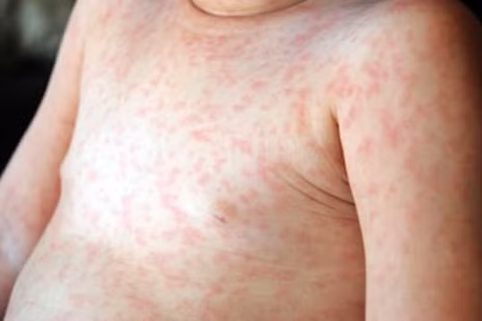 Bộ Y tế yêu cầu TP.HCM khẩn trương tăng cường giải pháp ứng phó với dịch sởi