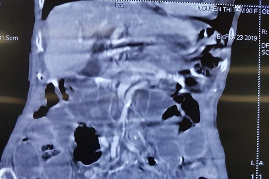 Hình ảnh chụp CT của bệnh nhân