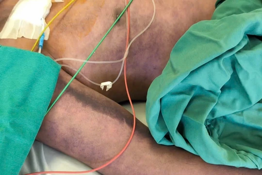 Người đàn ông rơi vào nguy kịch sau khi ăn lòng lợn