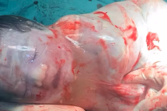 Kỳ diệu bé trai sinh ra trong “bọc điều” ở Hà Nội, chỉ xuất hiện 1/80.000 ca