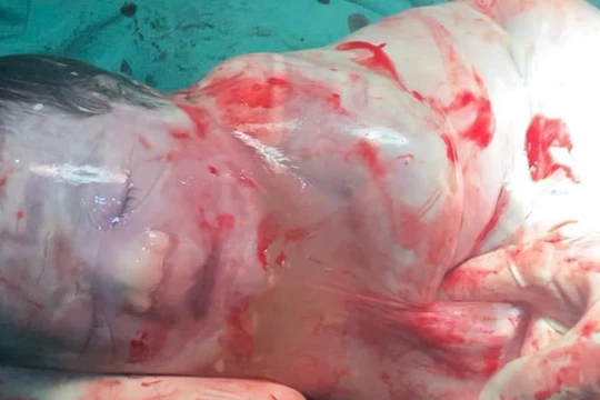 Kỳ diệu bé trai sinh ra trong “bọc điều” ở Hà Nội, chỉ xuất hiện 1/80.000 ca