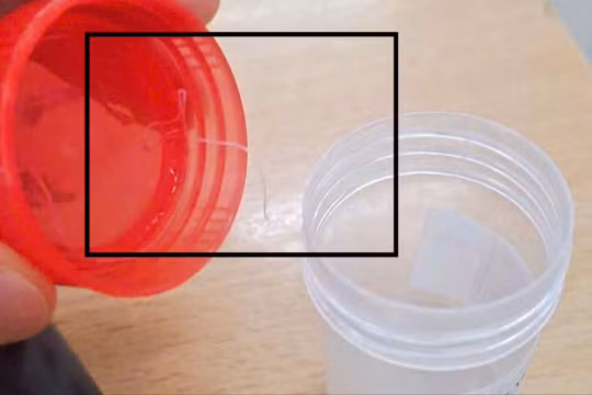 Hiếm gặp: Ký sinh trùng nghi là giun rồng dài 10 cm trong mắt người phụ nữ 