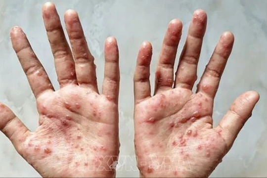 WHO công bố tình trạng khẩn cấp toàn cầu do bệnh đậu mùa khỉ lần thứ hai 