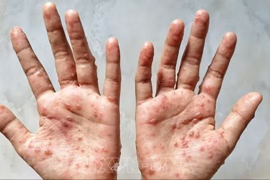 WHO công bố tình trạng khẩn cấp toàn cầu do bệnh đậu mùa khỉ lần thứ hai 