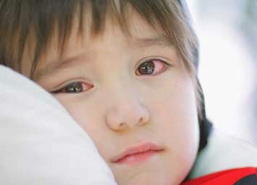 Rất nhiều trẻ em đã phải nhập viện điều trị vì đau mắt đỏ
