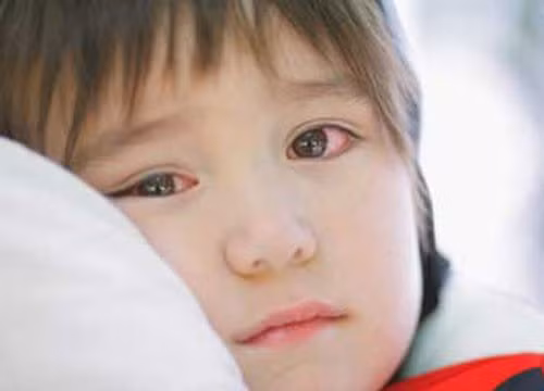 Rất nhiều trẻ em đã phải nhập viện điều trị vì đau mắt đỏ