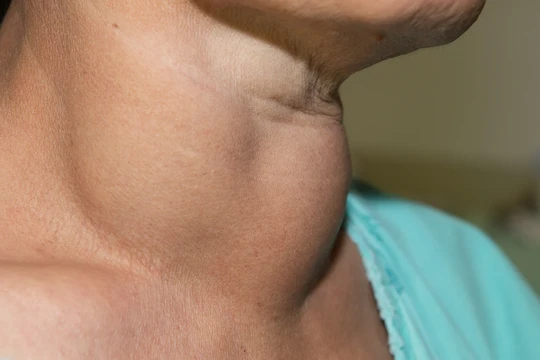 Doanh nghiệp phản đối bổ sung vi chất dinh dưỡng vào muối, bột mì: Các nhà khoa học nói gì? 