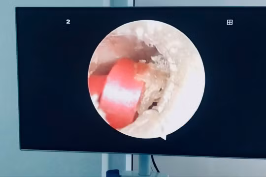 Sợi dây buộc tóc suýt làm bé gái 6 tuổi thủng màng nhĩ